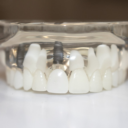 Dental implants