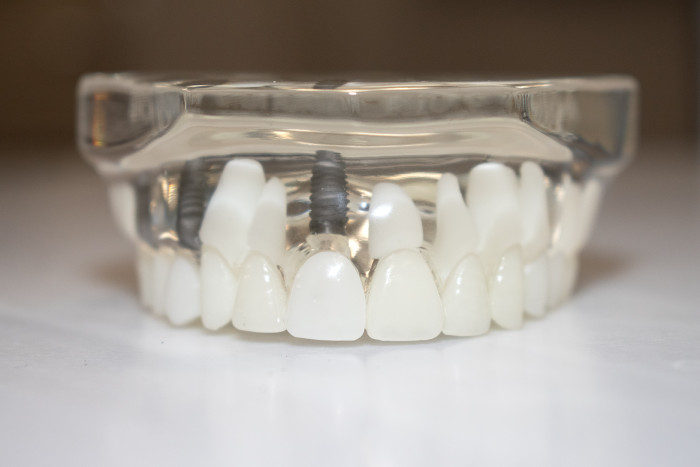Dental implants